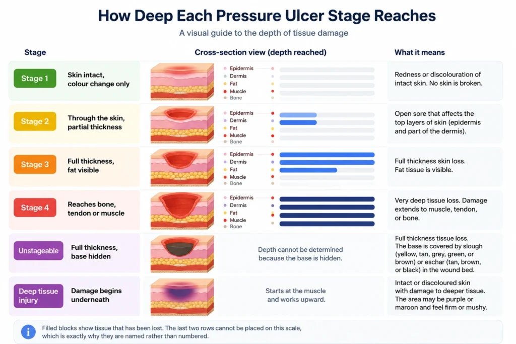 Infographic Diagram of the Pressure Ulcer Stages