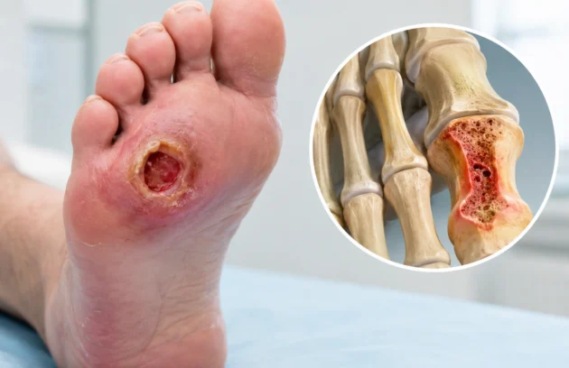 Signs a Foot Ulcer Has Reached the Bone