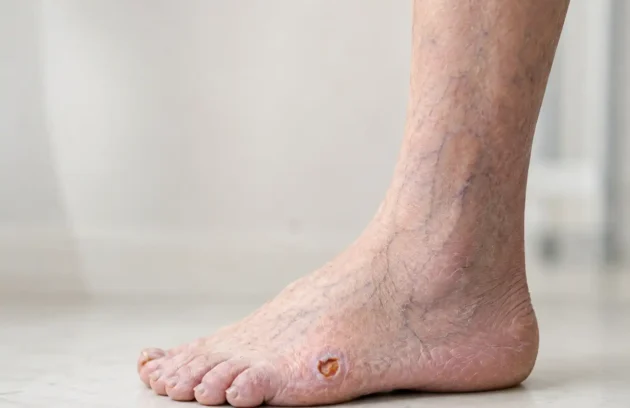 Close-up of an older adult’s foot showing a small arterial ulcer on the outer foot, with dry skin and visible veins.